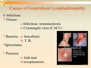 Causes of Generalised Lymphadenopathy
I- Infectious
* Viruses:
a-Infectious mononucleosis
b-Cytomegalo virus (C.M.V.)
* Bacteria: a- brucellosis
b- T .B.
*Spirochetes:
* Protozoa
a- kala azar
b-toxoplasmosis.
 