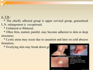 6- T.B.:
* The chiefly affected group is upper cervical group, generalized
L.N. enlargement is exceptional.
* Unilateral or Bilateral.
* Often firm, matted, painful, may become adherent to skin or deep
structures.
* Cystic areas may occur due to caseation and later on cold abscess
formation.
* Overlying skin may break down giving T.B. ulcers or sinuses.
 