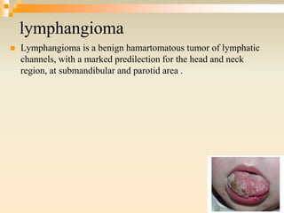 lymphangioma
 Lymphangioma is a benign hamartomatous tumor of lymphatic
channels, with a marked predilection for the head and neck
region, at submandibular and parotid area .
 