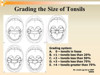 Dr. owais pg Ist yr ENT
SMHS
Grading the Size of Tonsils
Grading system:
A. 0 – tonsils in fossa
B. +1 – tonsils less than 25%
C. +2 – tonsils less than 50%
D. +3 – tonsils less than 75%
E. +4 – tonsils greater than 75%
 