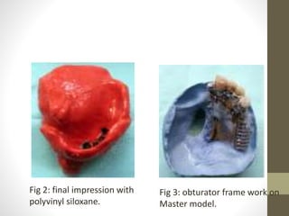Fig 2: final impression with 
polyvinyl siloxane. 
Fig 3: obturator frame work on 
Master model. 
 