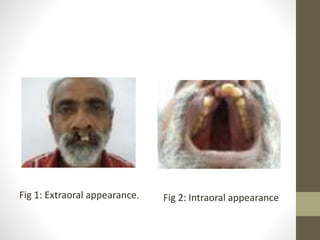Fig 1: Extraoral appearance. Fig 2: Intraoral appearance 
 