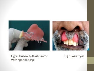 Fig 5 : Hollow bulb obturator 
With special clasp. 
Fig 6: wax try-in 
 