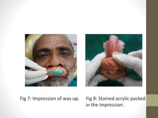 Fig 7: Impression of wax up. Fig 8: Stained acrylic packed 
in the impression. 
 