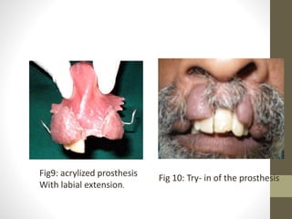 Fig9: acrylized prosthesis 
With labial extension. 
Fig 10: Try- in of the prosthesis 
 