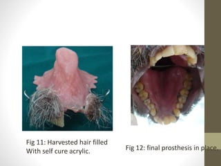 Fig 11: Harvested hair filled 
With self cure acrylic. Fig 12: final prosthesis in place. 
 