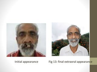Initial appearance Fig 13: final extraoral appearance 
