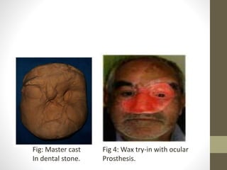 Fig: Master cast 
In dental stone. 
Fig 4: Wax try-in with ocular 
Prosthesis. 
 