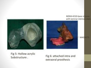Fig 5: Hollow acrylic 
Substructure . 
MDX4-4210-base silicone 
with laminar intrinsic stain. 
MAGNETS 
Fig 6: attached intra and 
extraoral prosthesis 
 