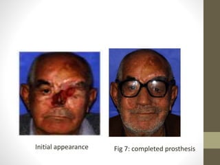 Initial appearance Fig 7: completed prosthesis 
 