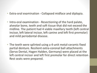 • Extra-oral examination - Collapsed midface and diplopia. 
• Intra-oral examination - Resectioning of the hard palate, 
alveolar bone, teeth and soft tissue that did not exceed the 
midline. The patient had 4 viable maxillary teeth (left central 
incisor, left lateral incisor, left canine and left first premolar) 
and mild periodontal disease. 
• The teeth were splinted using a 4-unit metal-ceramic fixed 
partial denture. Resilient extra-coronal ball attachments 
(Servo Dental, Hagen Halden, Germany) were placed at the 
left central incisor and left first premolar for direct retention . 
Rest seats were prepared. 
 