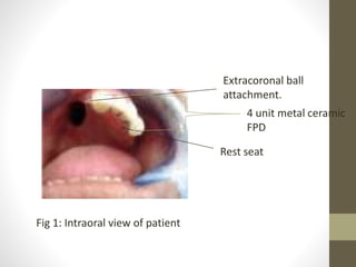 Fig 1: Intraoral view of patient 
Extracoronal ball 
attachment. 
4 unit metal ceramic 
FPD 
Rest seat 
 