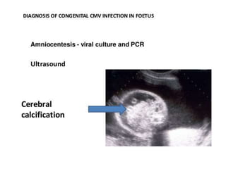 Diagosis In foetus
Amniocentisis : viral culture and PCR
Ultrasound
 