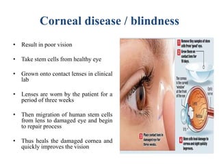 Corneal disease / blindness
• Result in poor vision
• Take stem cells from healthy eye
• Grown onto contact lenses in clinical
lab
• Lenses are worn by the patient for a
period of three weeks
• Then migration of human stem cells
from lens to damaged eye and begin
to repair process
• Thus heals the damaged cornea and
quickly improves the vision
 