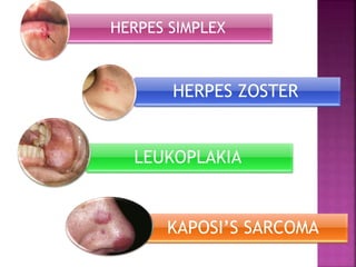 HERPES SIMPLEX
HERPES ZOSTER
LEUKOPLAKIA
KAPOSI’S SARCOMA
 