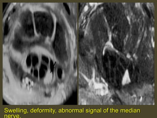 Swelling, deformity, abnormal signal of the median
nerve.
 