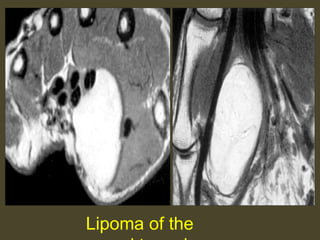 Lipoma of the
 