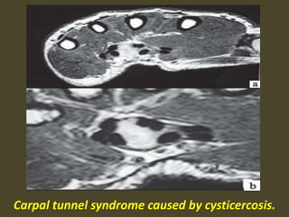 Carpal tunnel syndrome caused by cysticercosis.
 
