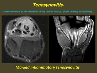 Tenosynovitis.
Tenosynovitis is an inflammation of the tendon sheath , either primary or secondary.
Marked inflammatory tenosynovitis.
 