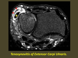 Tenosynovitis of Extensor Carpi Ulnaris.
 