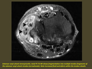 Extensor carpi ulnaris tenosynovitis. Axial FS T2-WI shows fragmentation into multiple tendon fragments of
the extensor carpi ulnaris tendon (arrowheads). Note increased fluid and debris within the tendon sheath.
 