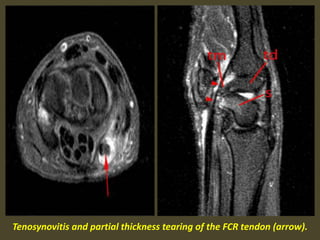 Tenosynovitis and partial thickness tearing of the FCR tendon (arrow).
 