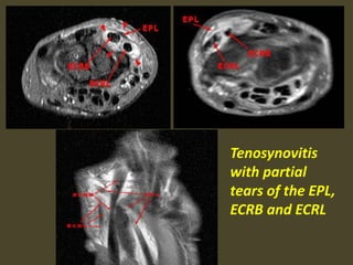 Tenosynovitis
with partial
tears of the EPL,
ECRB and ECRL
 