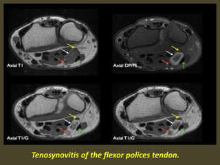 Tenosynovitis of the flexor polices tendon.
 