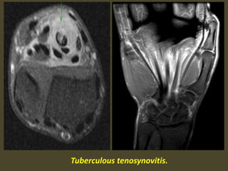 Tuberculous tenosynovitis.
 