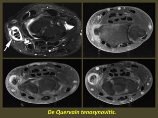 De Quervain tenosynovitis.
 