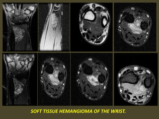 SOFT TISSUE HEMANGIOMA OF THE WRIST.
 