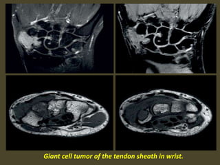 Giant cell tumor of the tendon sheath in wrist.
 