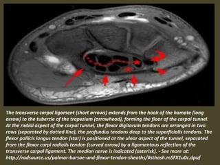 The transverse carpal ligament (short arrows) extends from the hook of the hamate (long
arrow) to the tubercle of the trapezium (arrowhead), forming the floor of the carpal tunnel.
At the radial aspect of the carpal tunnel, the flexor digitorum tendons are arranged in two
rows (separated by dotted line), the profundus tendons deep to the superficialis tendons. The
flexor pollicis longus tendon (star) is positioned at the ulnar aspect of the tunnel, separated
from the flexor carpi radialis tendon (curved arrow) by a ligamentous reflection of the
transverse carpal ligament. The median nerve is indicated (asterisk). - See more at:
http://radsource.us/palmar-bursae-and-flexor-tendon-sheaths/#sthash.mSFX1u0c.dpuf
 