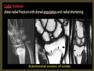 Subchondral erosion of lunate.
 