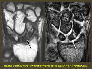 Scaphoid waist fracture with subtle collapse of the proximal pole, related AVN .
 