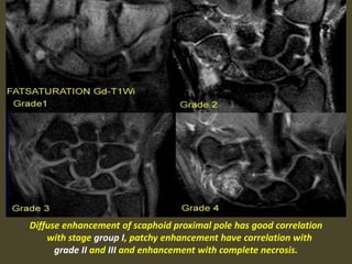 Diffuse enhancement of scaphoid proximal pole has good correlation
with stage group I, patchy enhancement have correlation with
grade II and III and enhancement with complete necrosis.
 