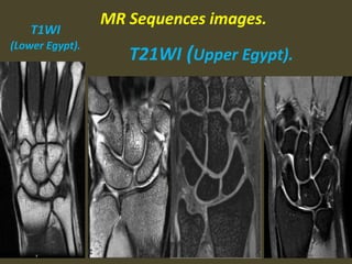 MR Sequences images.
T1WI
(Lower Egypt).
T21WI (Upper Egypt).
 