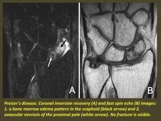 Preiser's disease. Coronal inversion recovery (A) and fast spin echo (B) images:
1. a bone marrow edema pattern in the scaphoid (black arrow) and 2.
avascular necrosis of the proximal pole (white arrow). No fracture is visible.
 