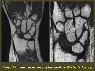 Idiopathic avascular necrosis of the scaphoid (Preiser’s disease)
 