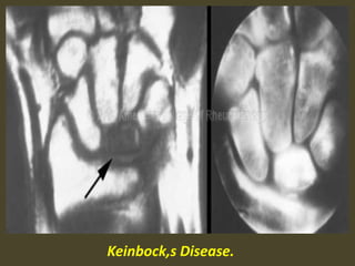 Keinbock,s Disease.
 