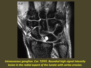 Intraosseous ganglion. Cor. T2FFE. Rounded high signal intensity
lesion in the radial aspect of the lunate with cortex erosion.
 