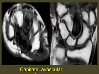 Capitate avascular
 