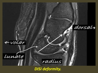 DISI deformity.
 