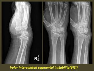 Volar intercalated segmental instability(VISI).
 