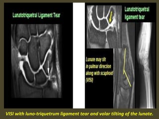 VISI with luno-triquetrum ligament tear and volar tilting of the lunate.
 