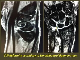 VISI deformity secondary to Lunotriquetral ligament tear.
 