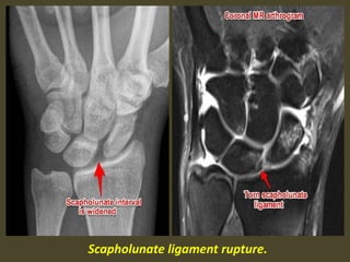Scapholunate ligament rupture.
 
