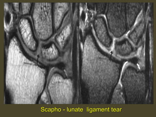 Scapho - lunate ligament tear
 