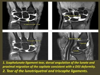 1. Scapholunate ligament tear, dorsal angulation of the lunate and
proximal migration of the capitate consistent with a DISI deformity.
2. Tear of the lunotriquetral and triscaphe ligaments.
 