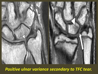 Positive ulnar variance secondary to TFC tear.
 